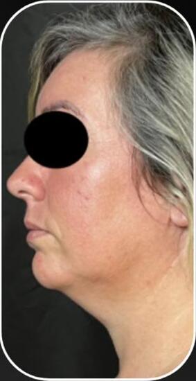 Depois — CONTORNO FACIAL E PAPADA